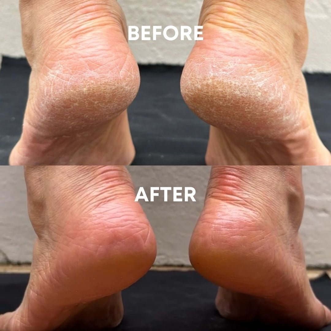 Heel care image 0